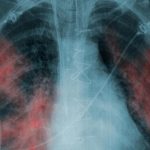 Új módszert alkalmaznak a tuberkulózis kimutatására Ukrajnában