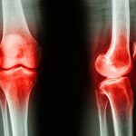 A világ egyik legkorábbi ismert reumatoid artritiszese