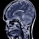 Az agydaganat immunterápiája túljutott a klinikai vizsgálatok első szakaszán