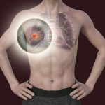 A tüdőrák egy „szokatlan” tünete, amely a kart érinti