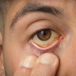 Daganatos elváltozás tünete lehet az étvágytalanság vagy a sárgás szem