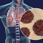 A tudósok jobb gyógymódot találtak az egyik agresszív ráktípusra